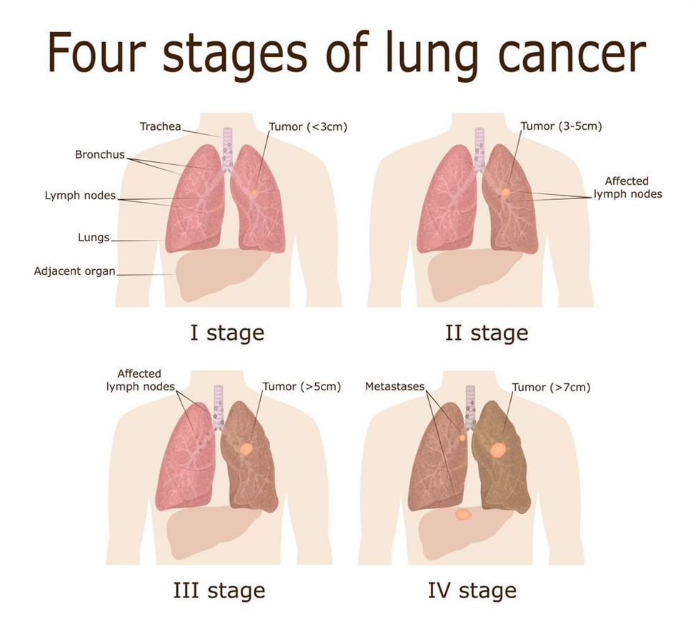 Lung Cancer Stages