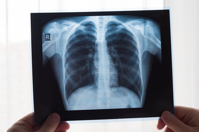 Lung xray