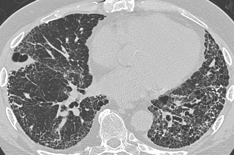 CT scan in a patient with usual interstitial pneumonia, showing interstitial thickening, architectural distortion, honeycombing and bronchiectasis.